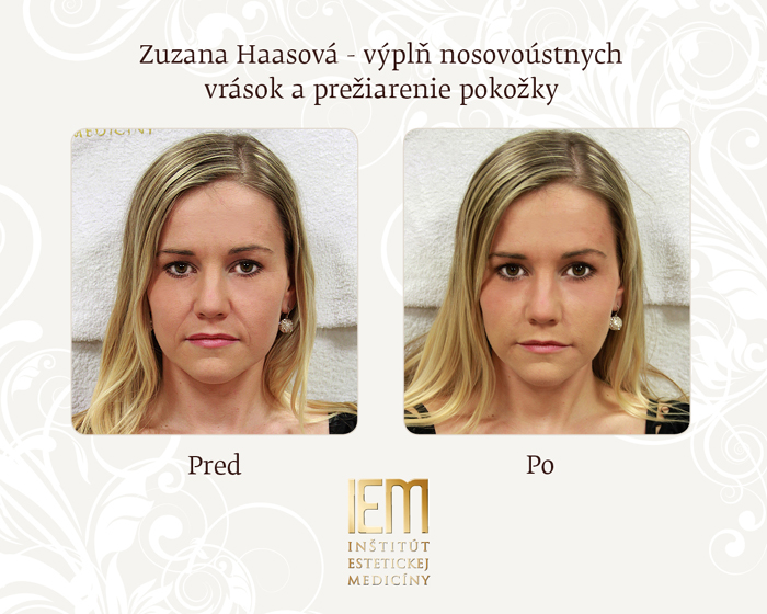 Zuzana Haasová: Zbavila sa vrások, a bezbolestne!