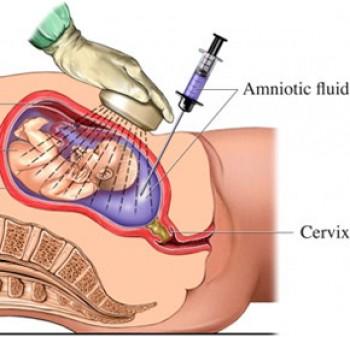Odber plodovej vody (amniocentéza) – kedy a prečo ju tehotné ženy majú podstúpiť?